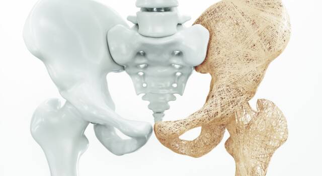 Che cos’è l’osteoporosi, come prevenirla